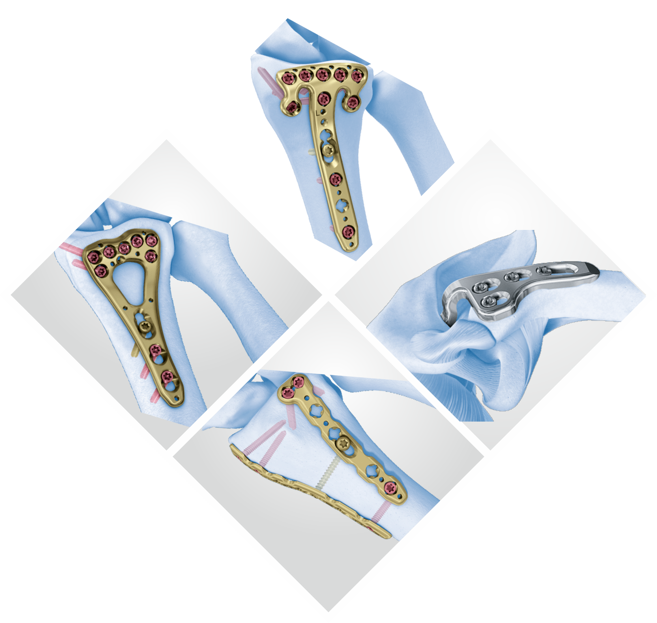 Advanced Orthopedic Bone Plates